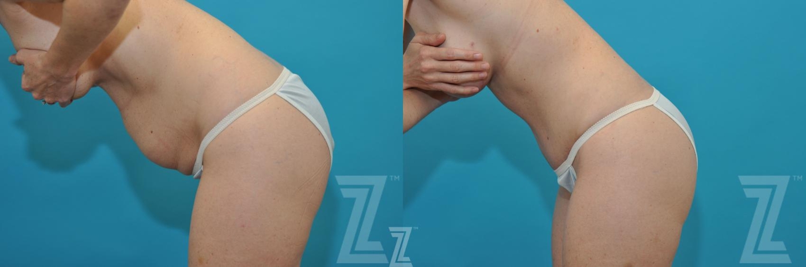 Austin oblique flexion view before & after images of 35 year old woman mommy make over - Dr. Rocco Piazza Austin TX - The Piazza Center