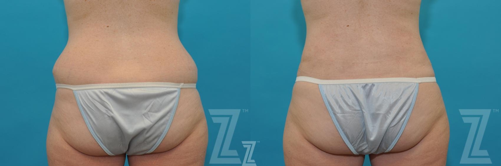 Austin Liposuction Before & After Gallery - Patient 132887304 - Image 3 - The Piazza Center