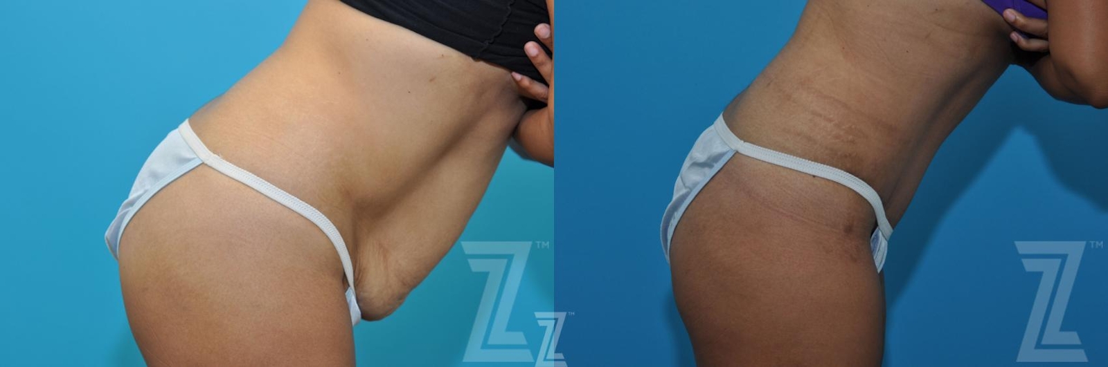 Austin Tummy Tuck Before & After Gallery - Patient 132886898 - Image 5 - The Piazza Center