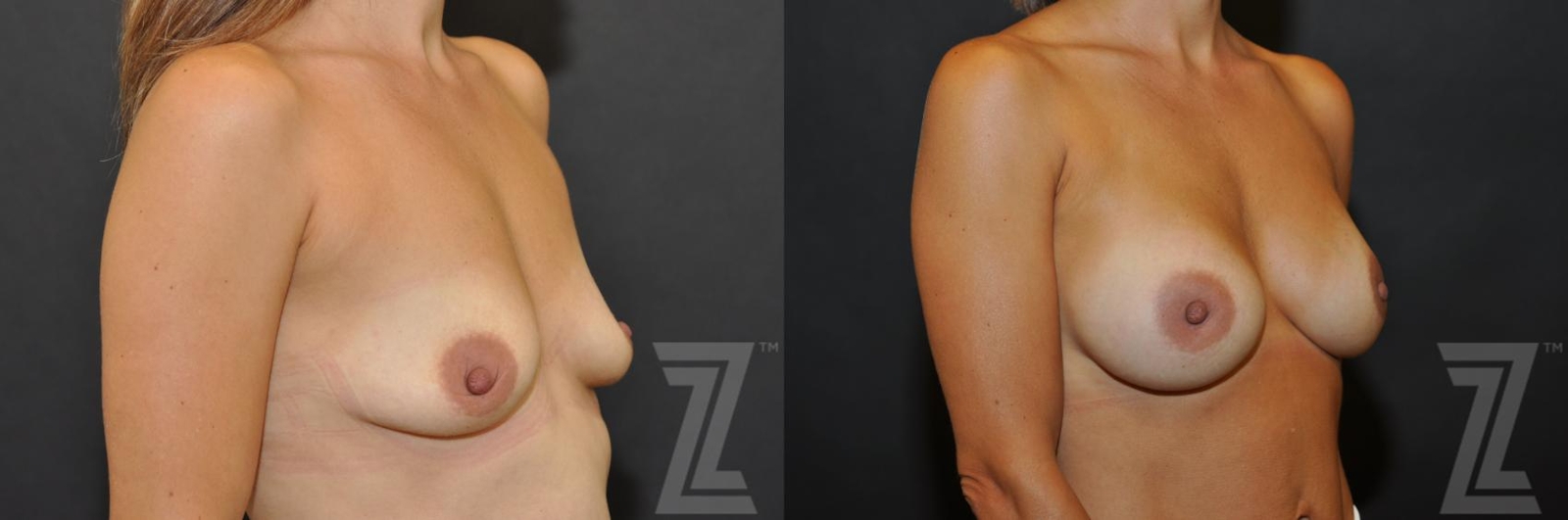 Austin oblique view before and after image of 36-year-old mother of four breast augmentation at the piazza center - The Piazza Center