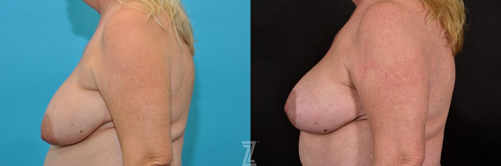 Austin Breast Lift Before & After Gallery - Patient 132791071 - Image 3 - The Piazza Center