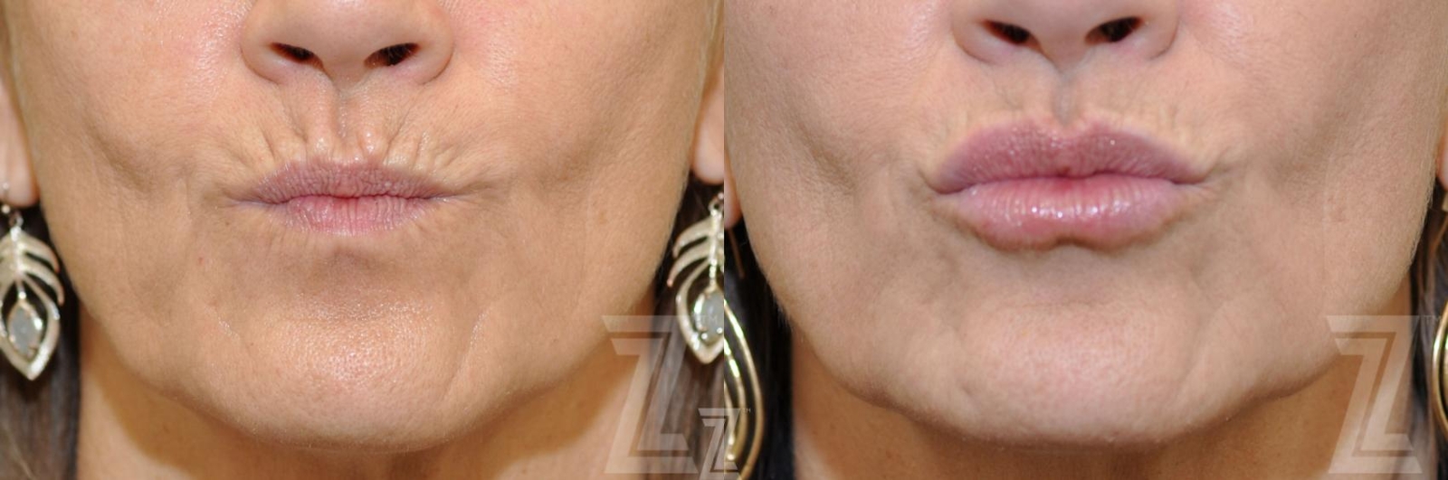 Austin Injectable Fillers Before & After Gallery - Patient 132963127 - Image 2 - The Piazza Center