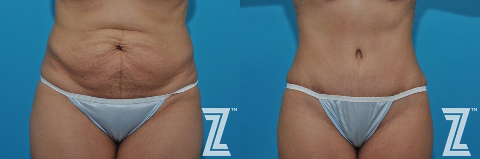 Austin Tummy Tuck Before & After Gallery - Patient 132886863 - Image 1 - The Piazza Center