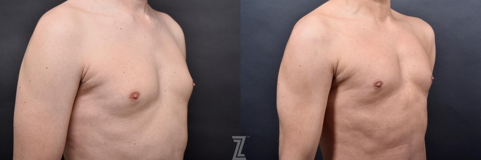 Austin Male Body Contouring Before & After Gallery - Patient 273342 - Image 7 - The Piazza Center