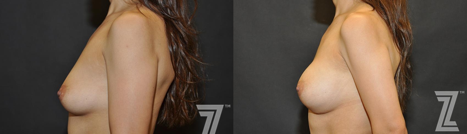 Austin Side view of before & after image of 40 year old woman with Silicone Implants with Cohesive Silicone Gel - The Piazza Center
