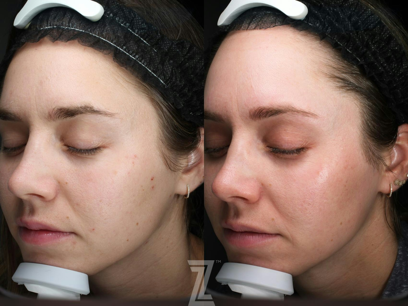 Austin SkinPen Microneedling Before & After Gallery - Patient 270635 - Image 1 - The Piazza Center
