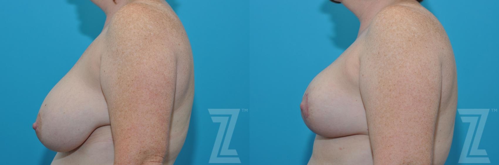 Austin Breast Reduction Before & After Gallery - Patient 132886606 - Image 3 - The Piazza Center