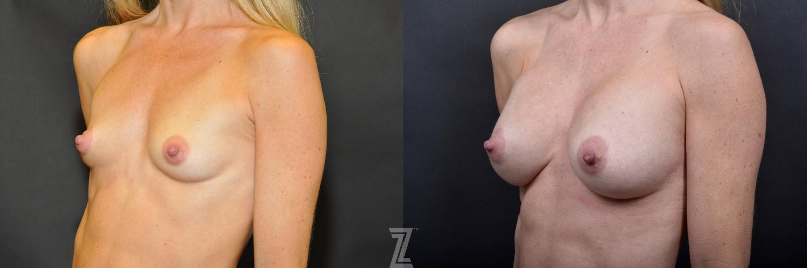 Austin Oblique View Before and After 4 year post op of 41 year old woman with Silicone Implants with Cohesive Silicone Gel - Dr. Rocco Piazza - The Piazza Center