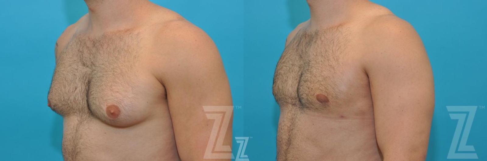 Austin Gynecomastia/Male Breast Reduction Before & After Gallery - Patient 118963 - Image 2 - The Piazza Center
