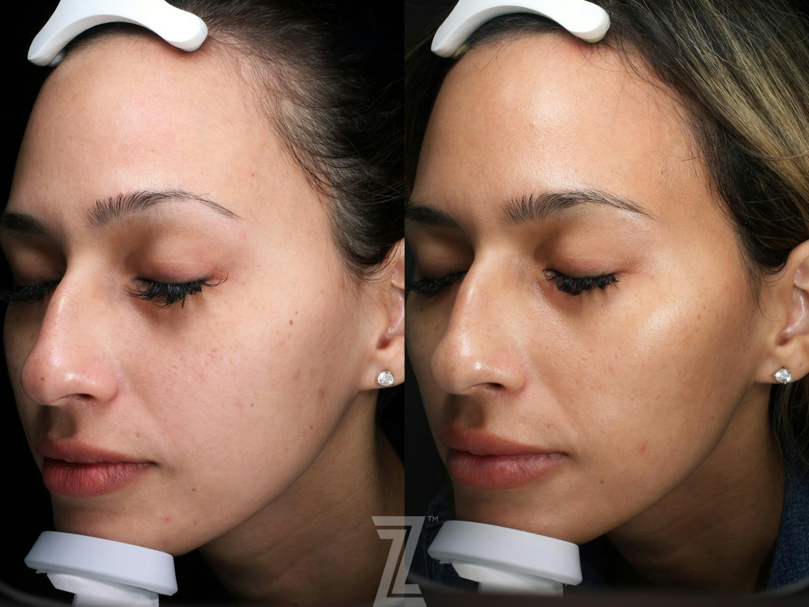 Austin HALO Before & After Gallery - Patient 104036 - Image 1 - The Piazza Center