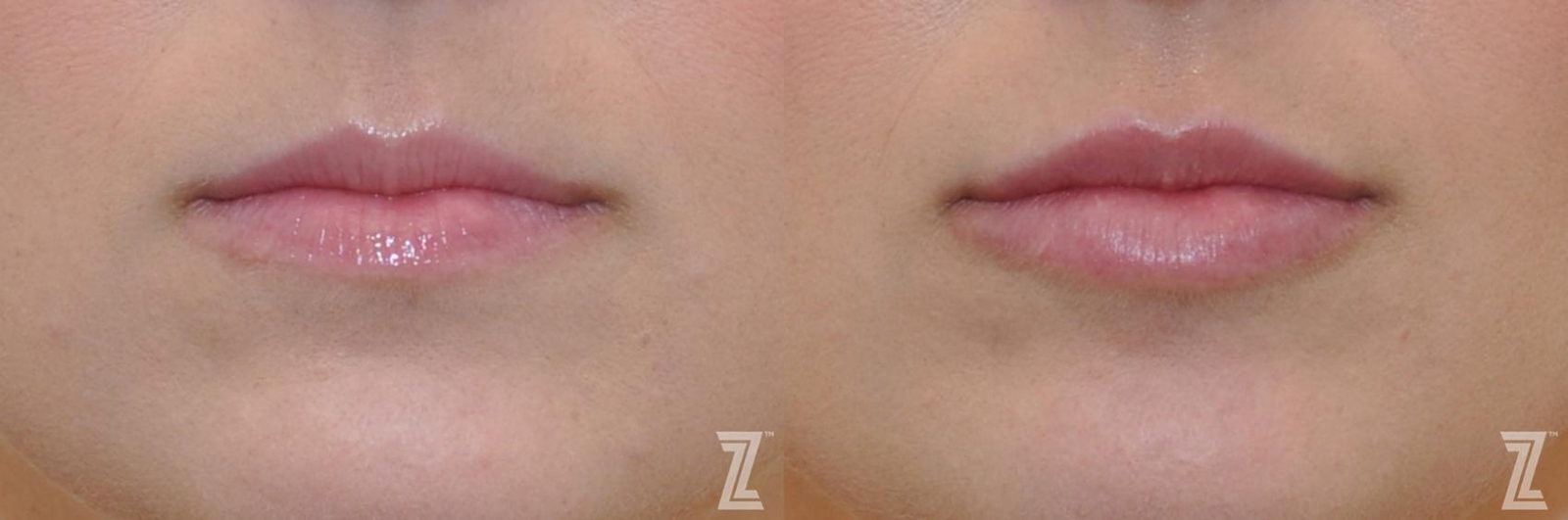 Austin Injectable Fillers Before & After Gallery - Patient 132963115 - Image 1 - The Piazza Center
