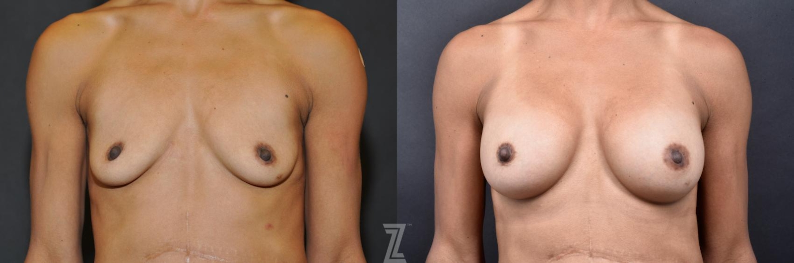 Austin Bilateral view before & after images of 35-year-old mother with breat augmentation - Dr. Rocco Piazza - The Piazza Center