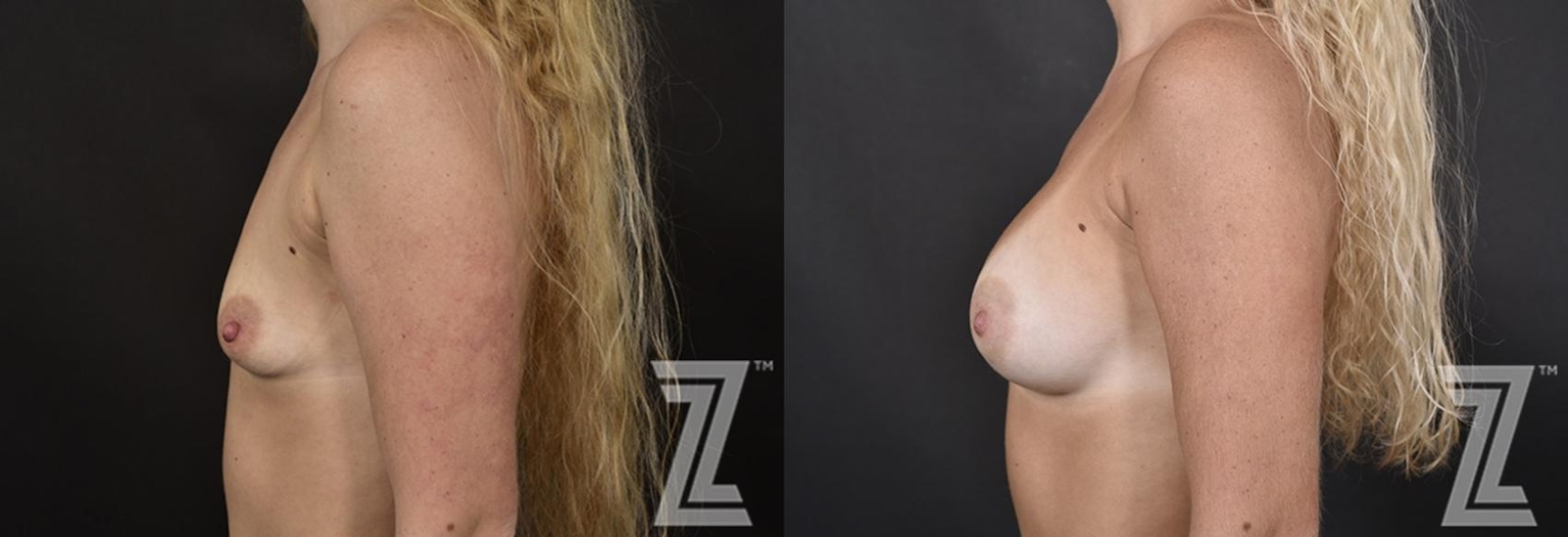 Austin Side view of before and after image of 23 year old woman with Silicone Implants with Cohesive Silicone Gel at the piazza center - The Piazza Center
