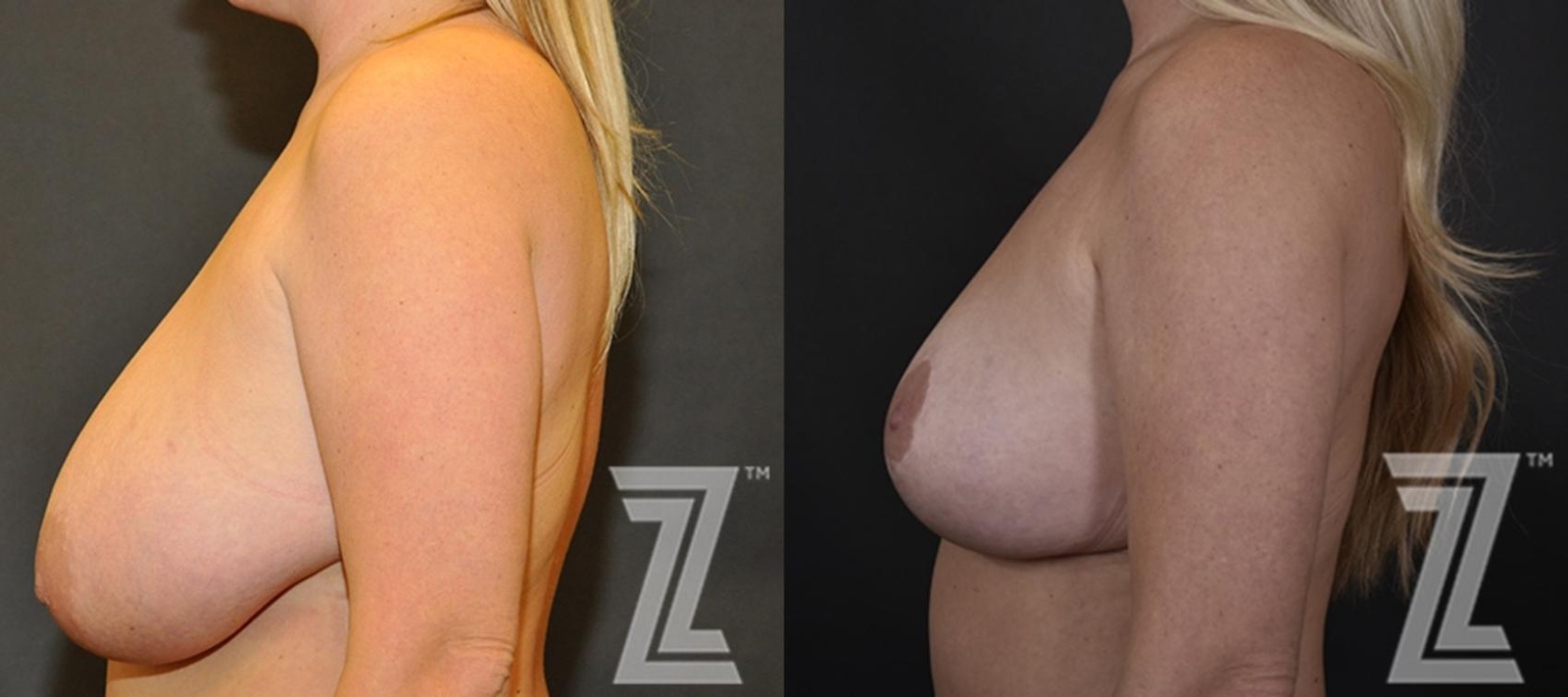 Austin Breast Reduction Before & After Gallery - Patient 132886746 - Image 3 - The Piazza Center