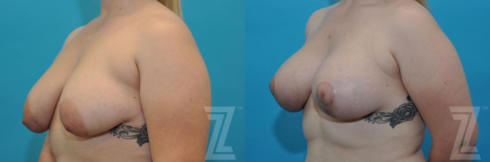 Austin Correction of Breast Asymmetry Before & After Gallery - Patient 132886777 - Image 2 - The Piazza Center