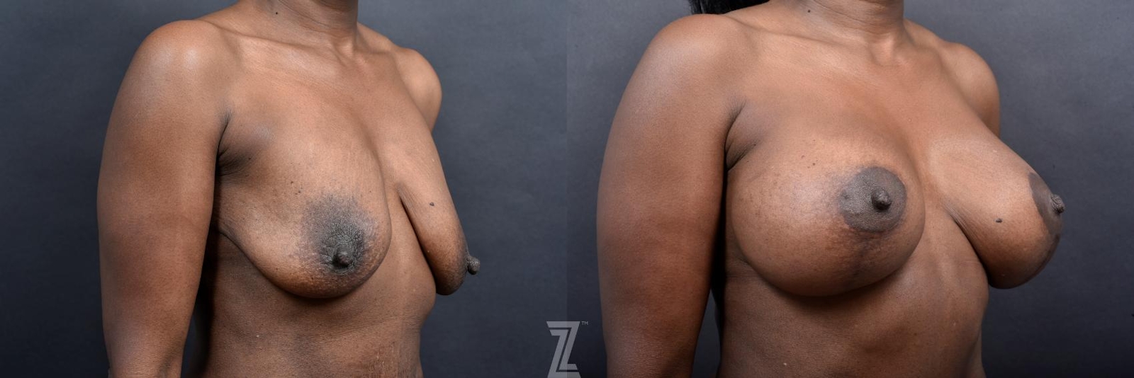 Austin 1 Year Post-OP Mommy Makeover in Austin, TX by Dr. Rocco Piazza - Oblique View of Breasts - The Piazza Center