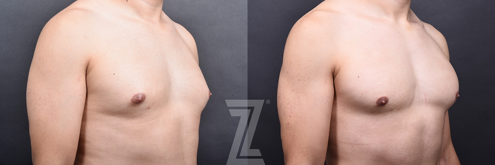 Austin Gynecomastia/Male Breast Reduction Before & After Gallery - Patient 105962 - Image 2 - The Piazza Center