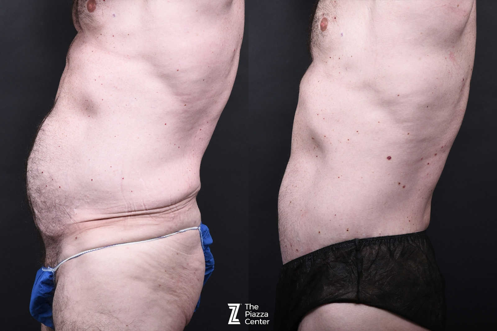Austin Male Body Contouring Before & After Gallery - Patient 207626 - Image 2 - The Piazza Center