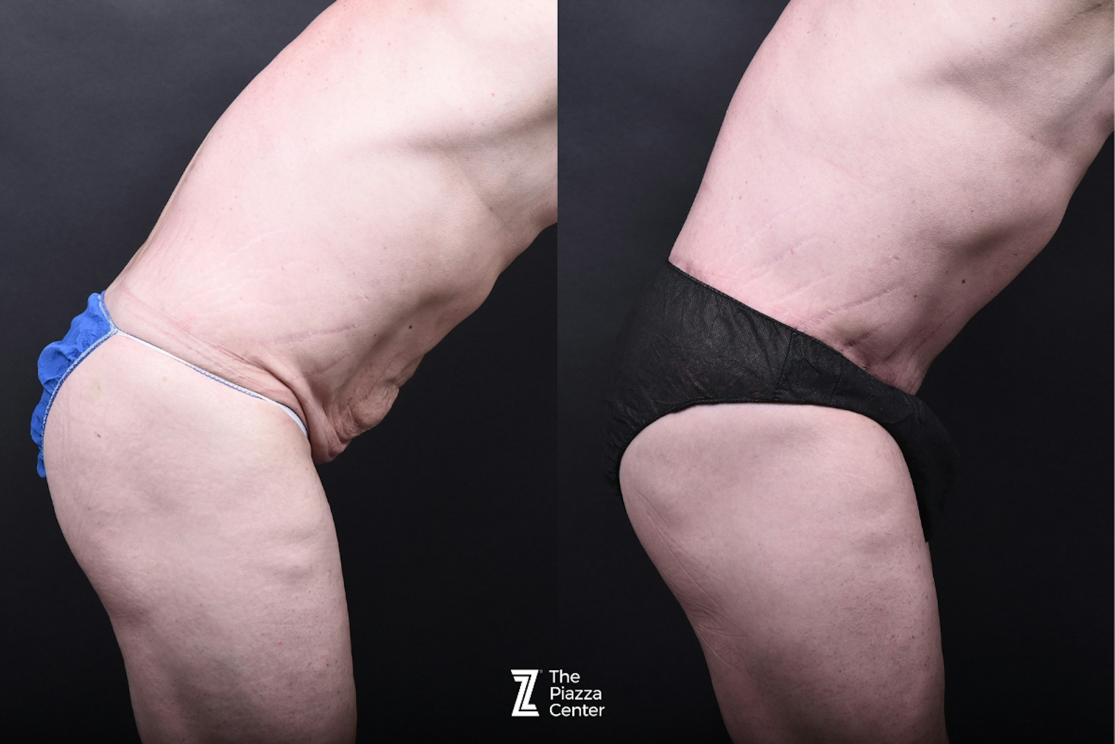Austin Tummy Tuck Before & After Gallery - Patient 830228 - Image 3 - The Piazza Center