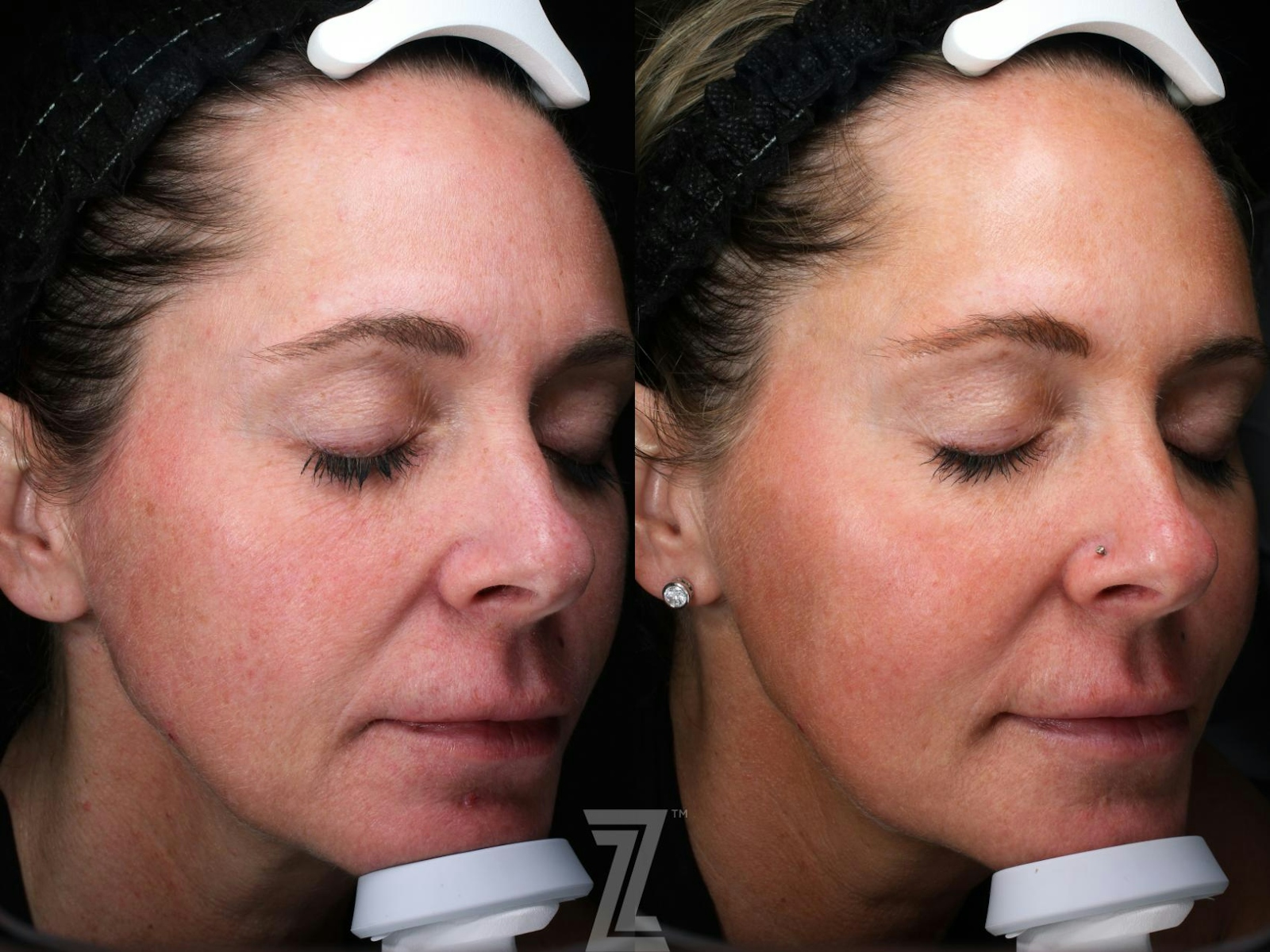 Austin Visia Skincare Analysis Before & After Gallery - Patient 132963268 - Image 3 - The Piazza Center