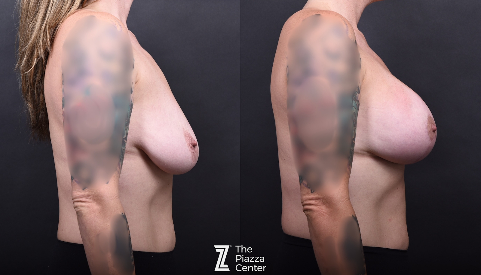 Austin Breast Augmentation With a Breast Lift Before & After Gallery - Patient 190151 - Image 3 - The Piazza Center