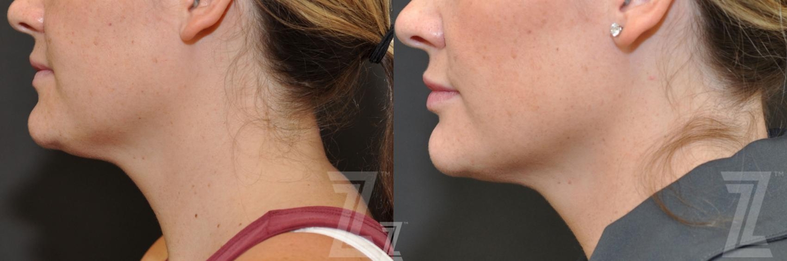 Austin KYBELLA® Before & After Gallery - Patient 132963129 - Image 3 - The Piazza Center