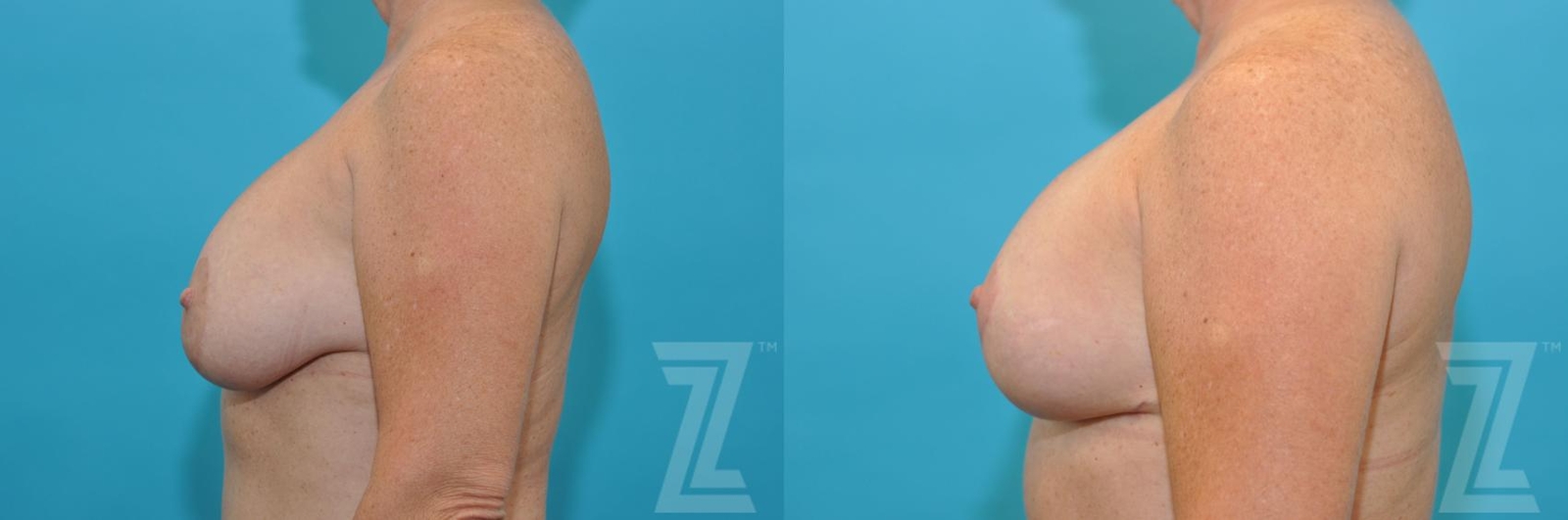 Austin Breast Augmentation Revision Before & After Gallery - Patient 132886540 - Image 3 - The Piazza Center