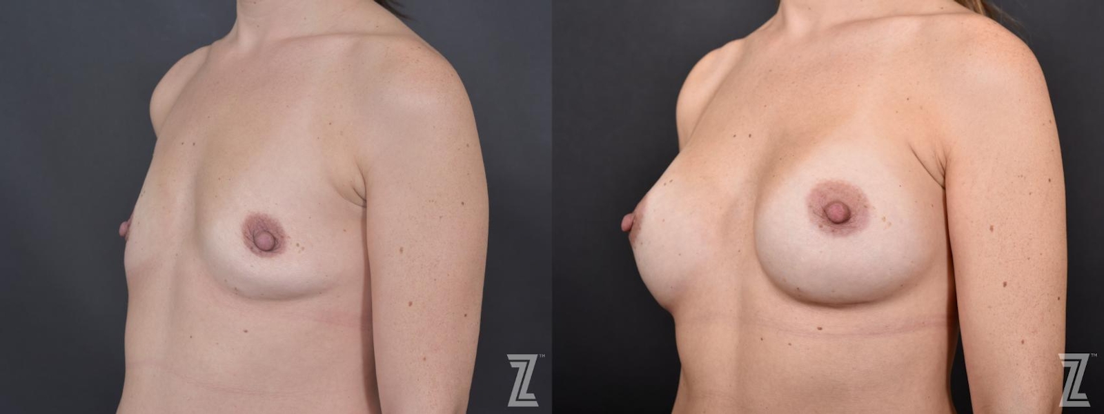 Austin Oblique view of before & after 2 year post op 36 year old woman with breast augmentation - The Piazza Center