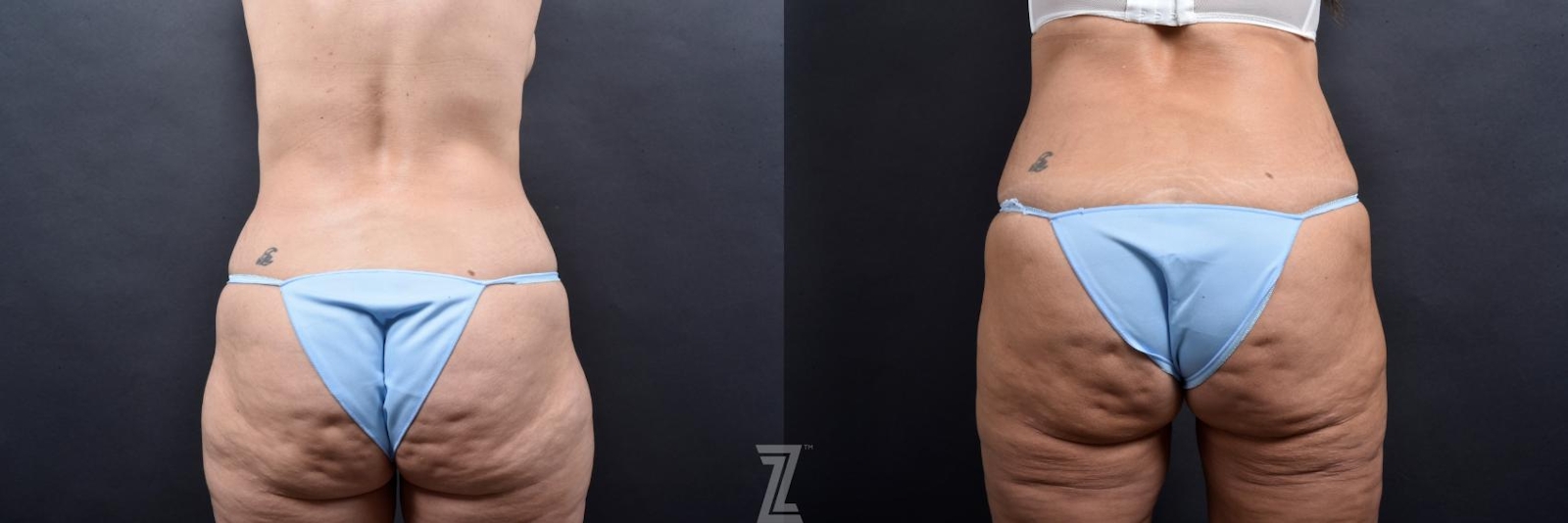 Austin Tummy Tuck Before & After Gallery - Patient 132886877 - Image 4 - The Piazza Center