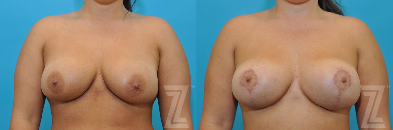Austin Breast Augmentation Revision Before & After Gallery - Patient 132886591 - Image 1 - The Piazza Center