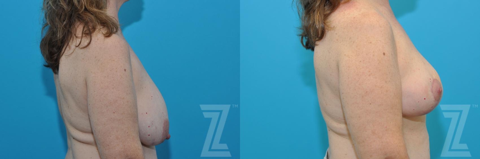 Austin Breast Reduction Before & After Gallery - Patient 132886744 - Image 5 - The Piazza Center