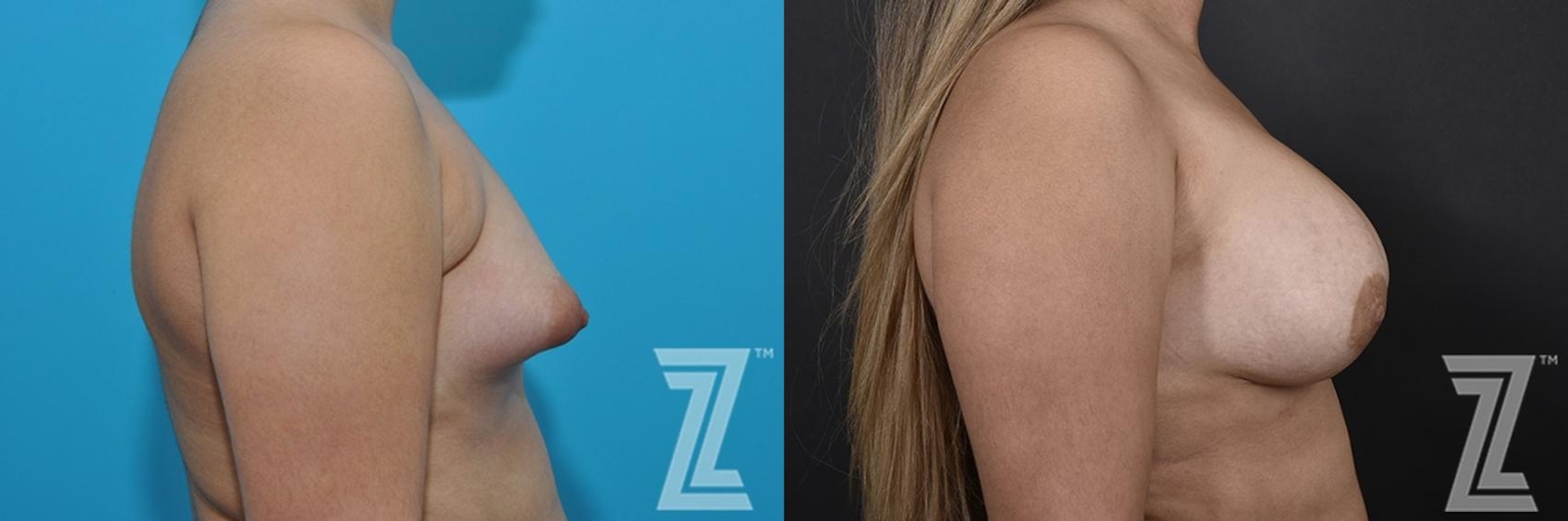 Austin Correction of Breast Asymmetry Before & After Gallery - Patient 132886781 - Image 5 - The Piazza Center