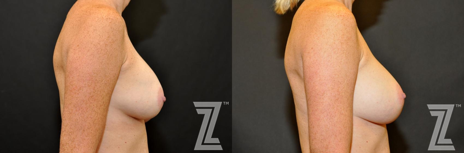 Austin Breast Augmentation Revision Before & After Gallery - Patient 132886587 - Image 5 - The Piazza Center
