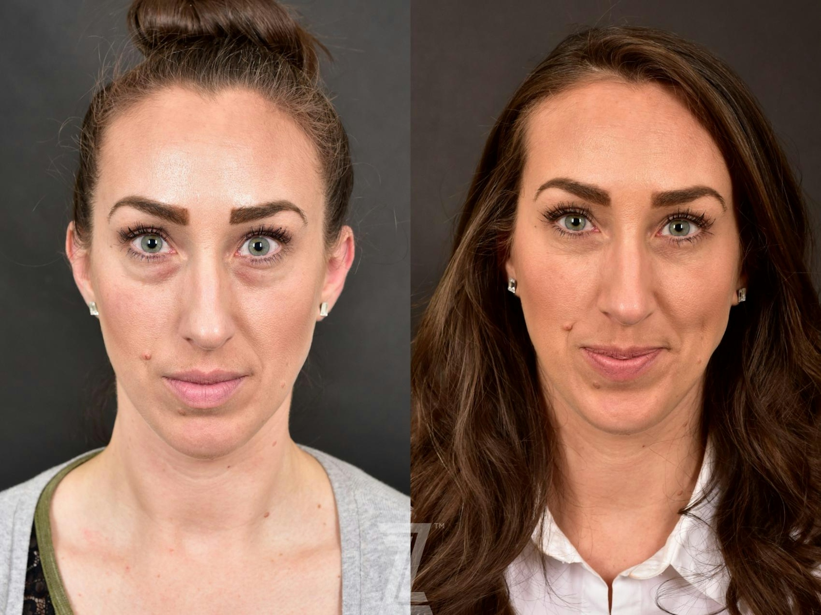 Austin Injectable Fillers Before & After Gallery - Patient 132963104 - Image 1 - The Piazza Center