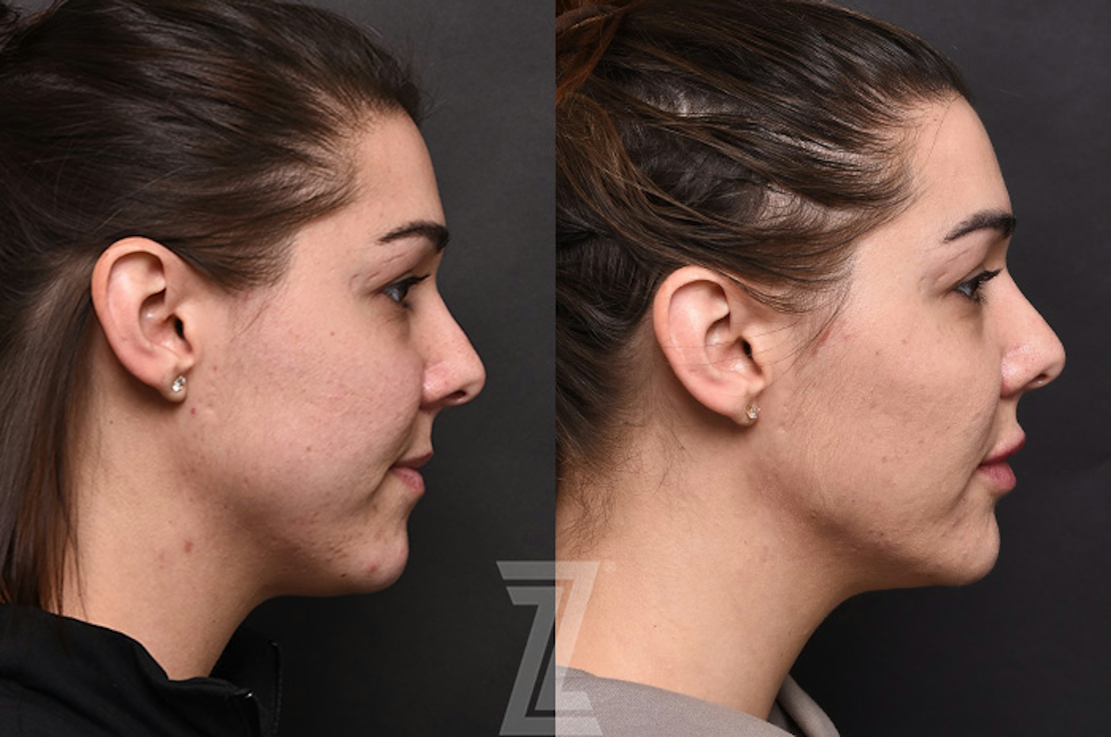 Austin Facial Rejuvenation Before & After Gallery - Patient 238339 - Image 3 - The Piazza Center