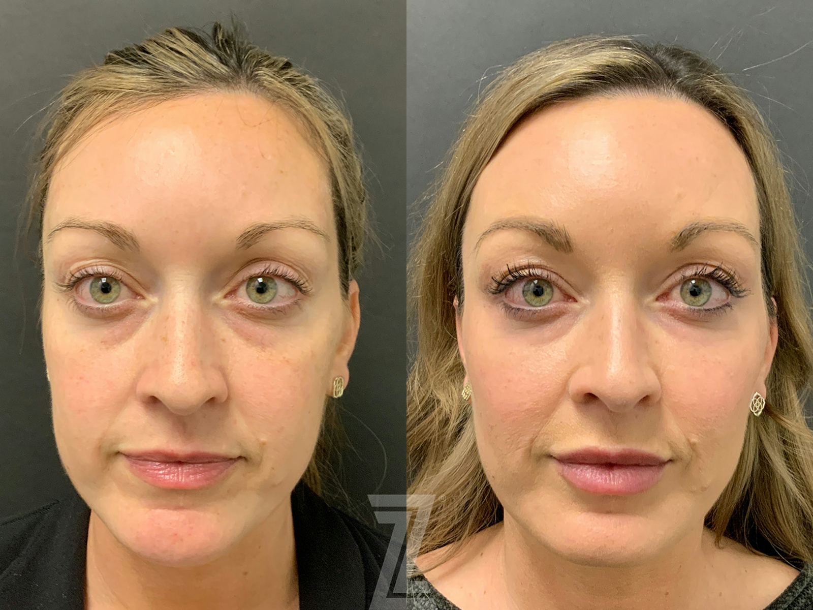 Austin Facial Rejuvenation Before & After Gallery - Patient 184295 - Image 1 - The Piazza Center