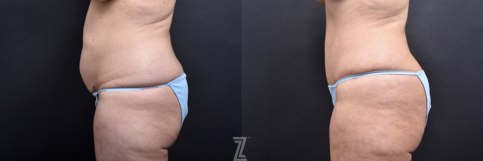 Austin Side View from Mommy Makeover of 41 year old woman in Austin, TX by Dr. Rocco Piazza - Before & After - The Piazza Center
