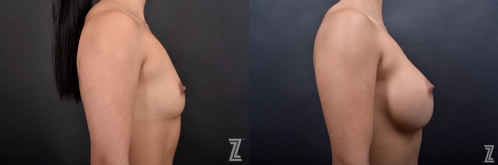 Austin Lateral View Before & After Breast Augmentation of 25-Year-Old Female Patient at The Piazza Center in Austin - Dr. Piazza - The Piazza Center