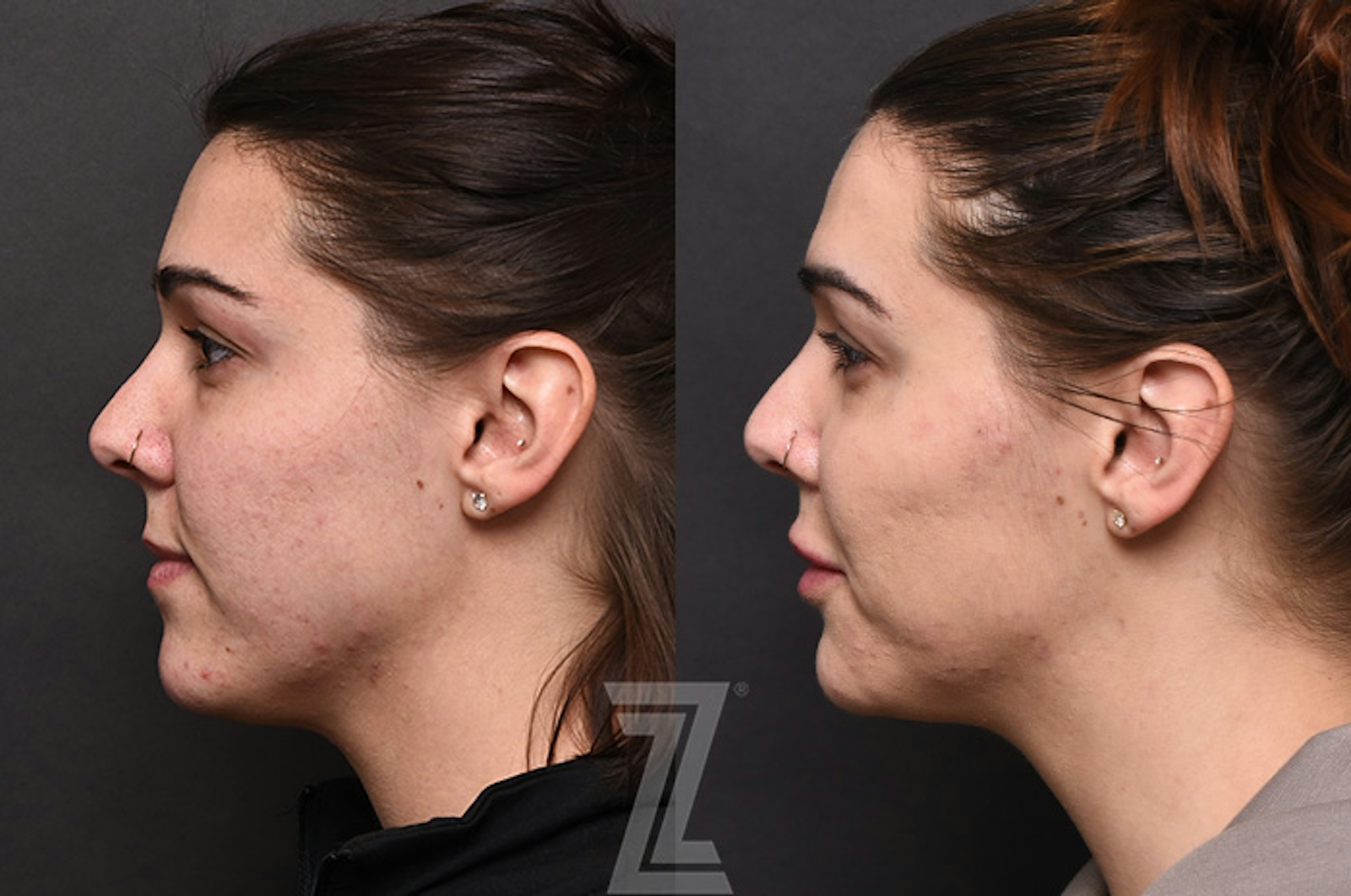 Austin Facial Rejuvenation Before & After Gallery - Patient 238339 - Image 5 - The Piazza Center