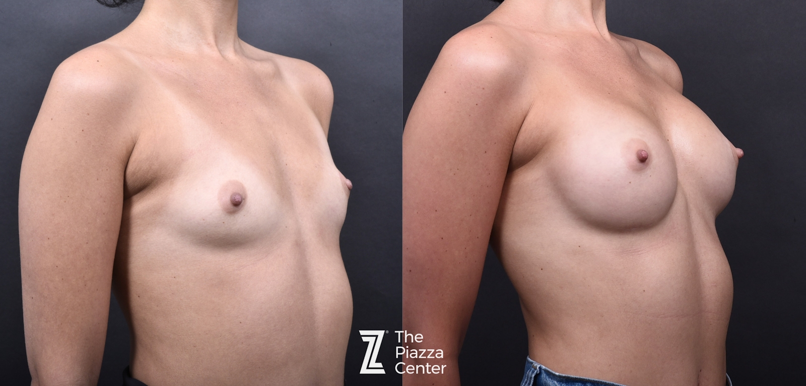 Austin Breast Augmentation Before & After Gallery - Patient 790705 - Image 2 - The Piazza Center