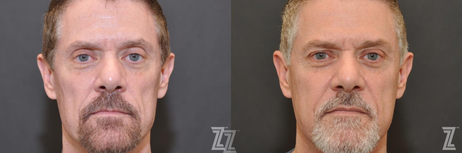 Austin Male Injectables Before & After Gallery - Patient 248412 - Image 2 - The Piazza Center
