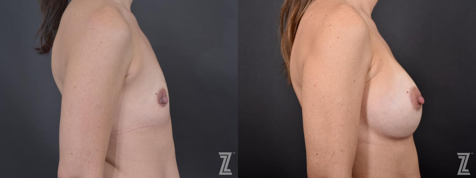 Austin Lateral view of before & after 2 year post op 36 year old woman with breast augmentation - The Piazza Center