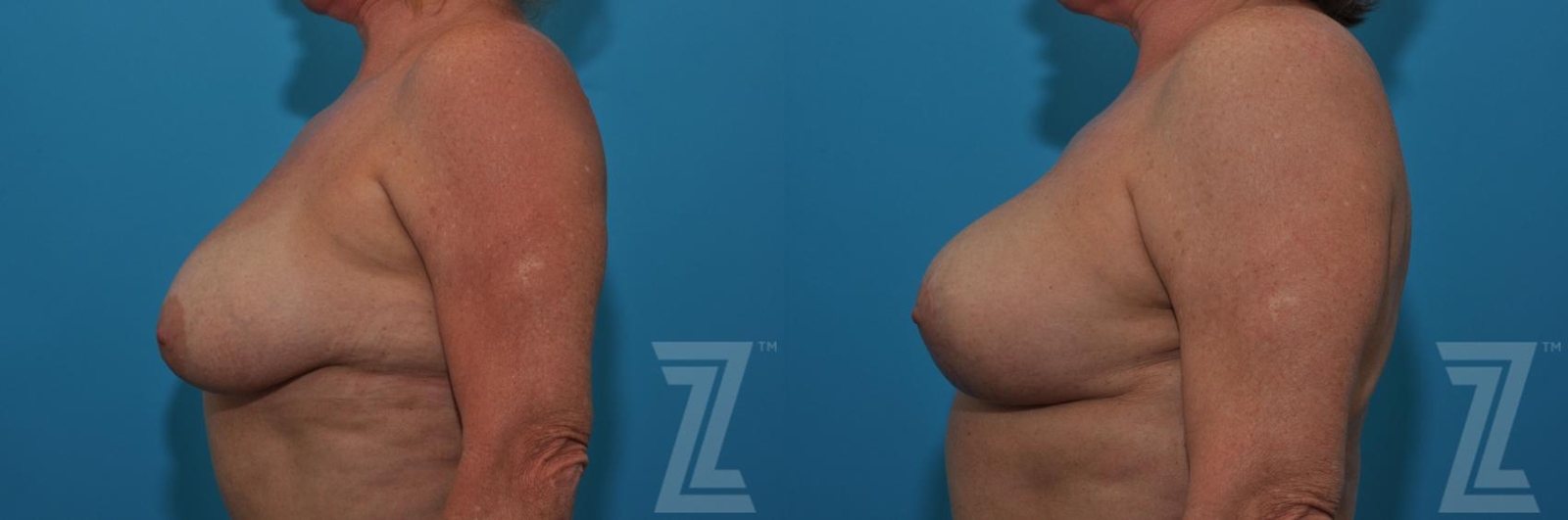 Austin Breast Lift Before & After Gallery - Patient 132791080 - Image 3 - The Piazza Center