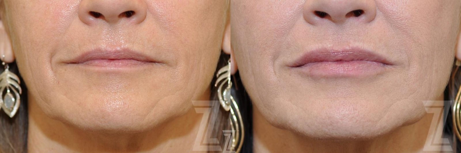 Austin Injectable Fillers Before & After Gallery - Patient 132963127 - Image 1 - The Piazza Center
