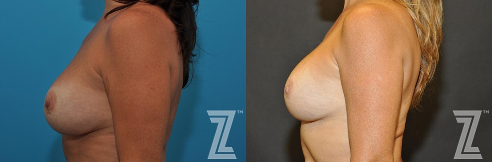 Austin Breast Augmentation Revision Before & After Gallery - Patient 132886563 - Image 3 - The Piazza Center
