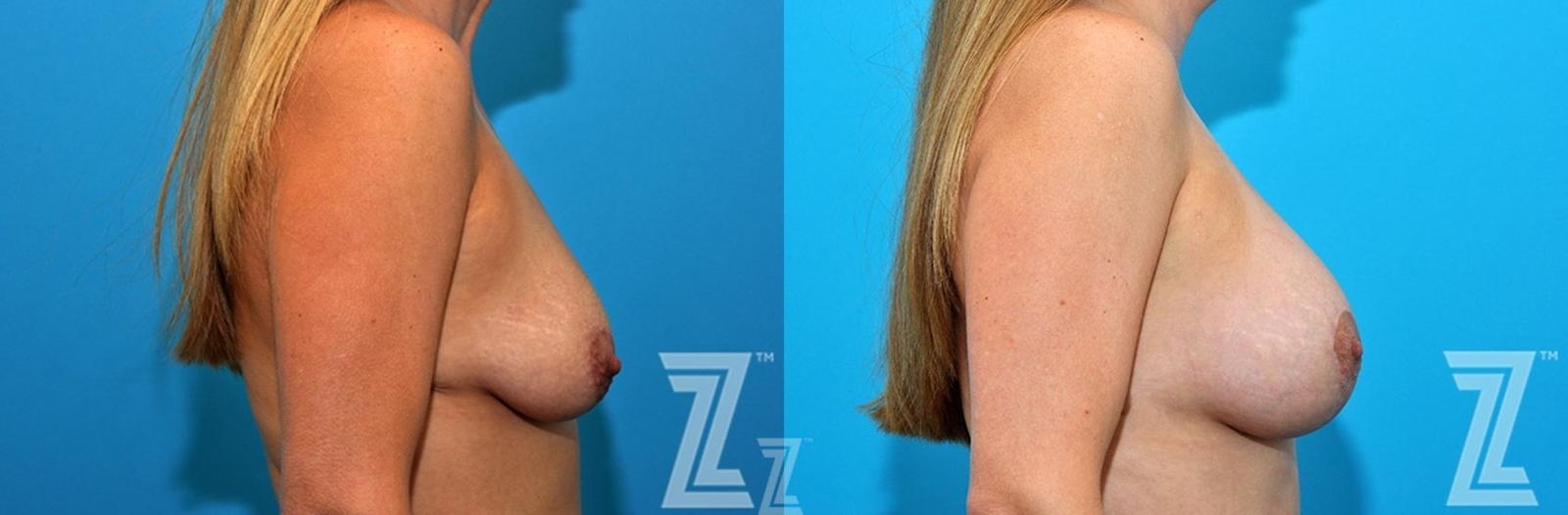 Austin Lateral breast view before and after images 36 year old woman 1 year post op mommy makeover - Austin Tx, The Piazza Center - The Piazza Center
