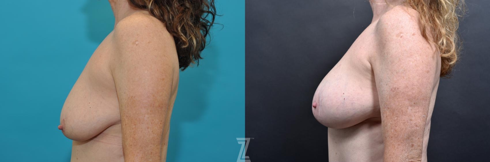 Austin Side breast view 7 year post op mommy makeover - The Piazza Center, Austin Tx - The Piazza Center