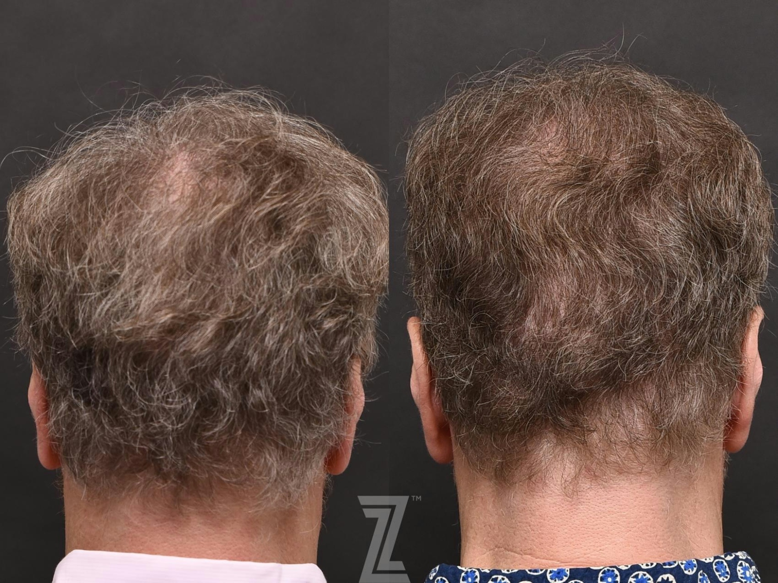Austin Male Hair Restoration Before & After Gallery - Patient 336127 - Image 3 - The Piazza Center