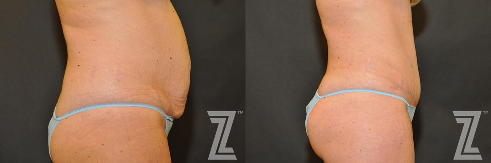 Austin Tummy Tuck Before & After Gallery - Patient 132886883 - Image 4 - The Piazza Center