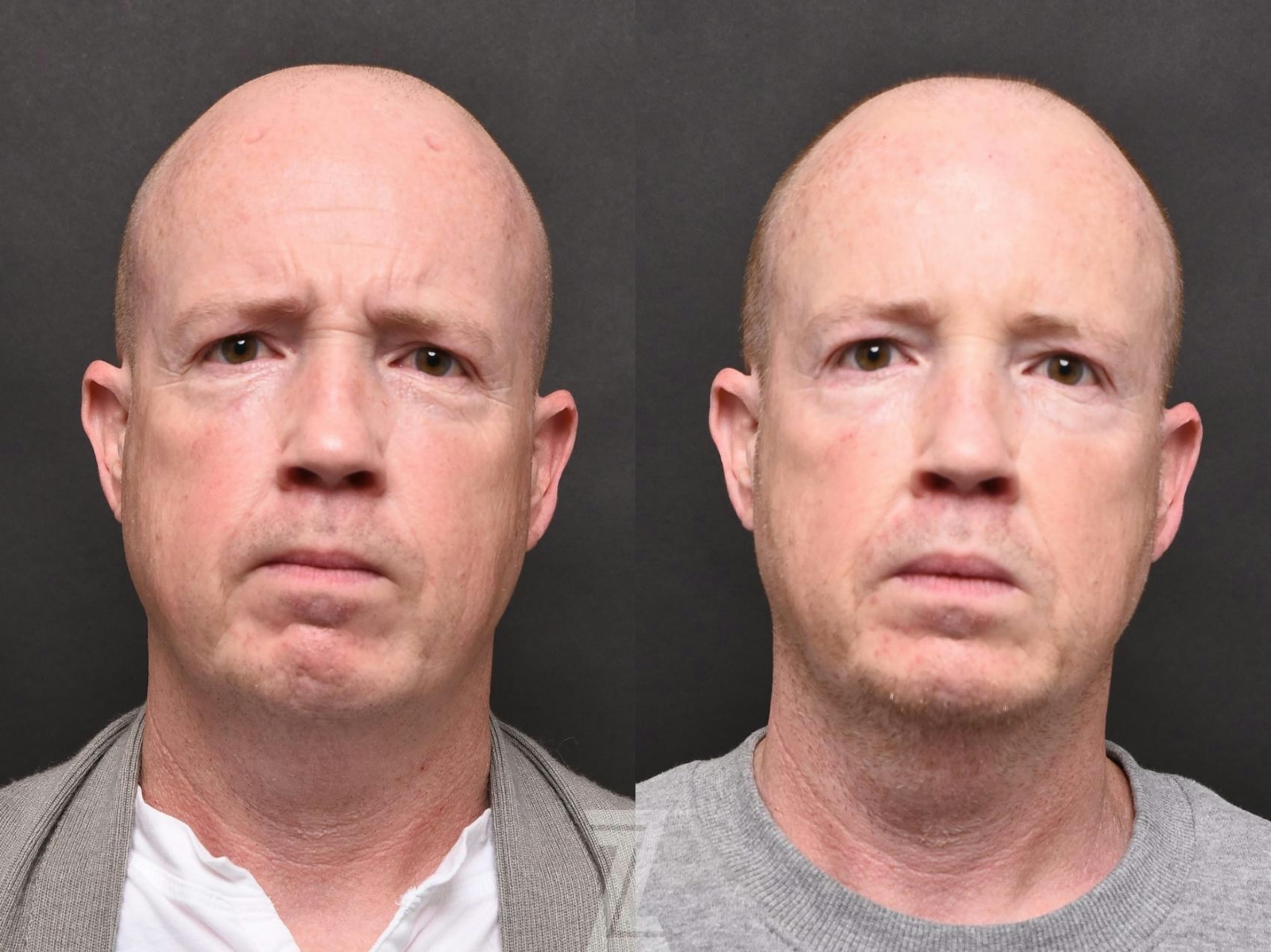 Austin Wrinkle Relaxers Before & After Gallery - Patient 132906313 - Image 2 - The Piazza Center